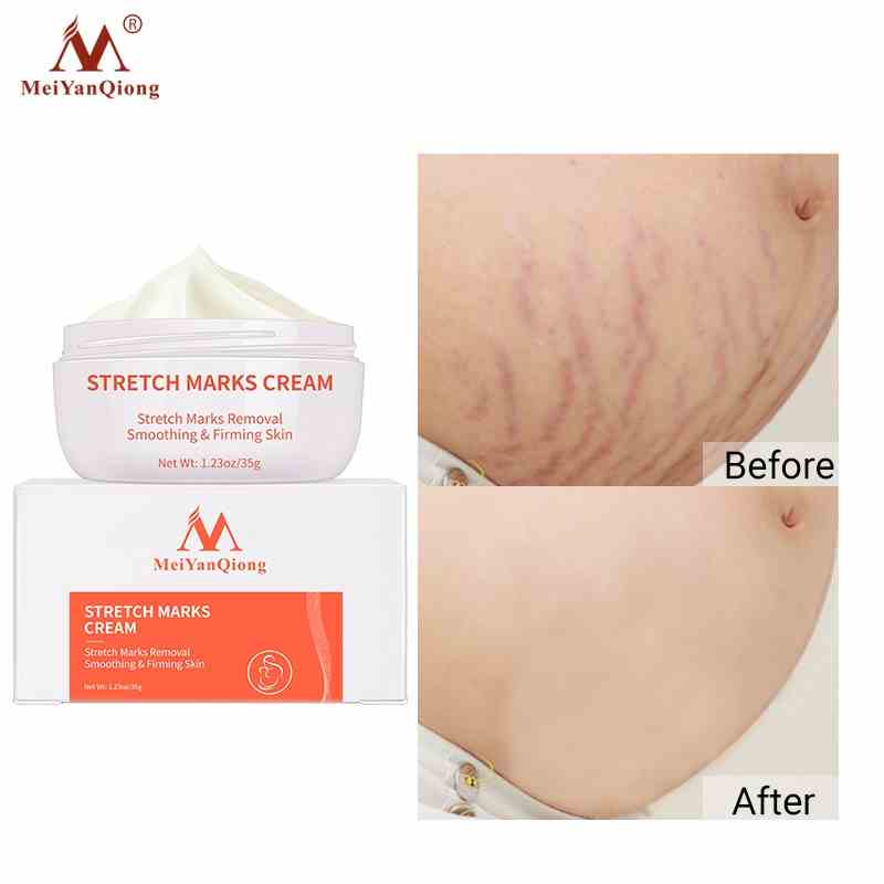 Meiyanqiong Stretch Mark Cream Làm Trắng Và Săn Chắc Mịn Mượt Chống Lão Hóa Giảm rạn da Kem dưỡng ẩm 35g