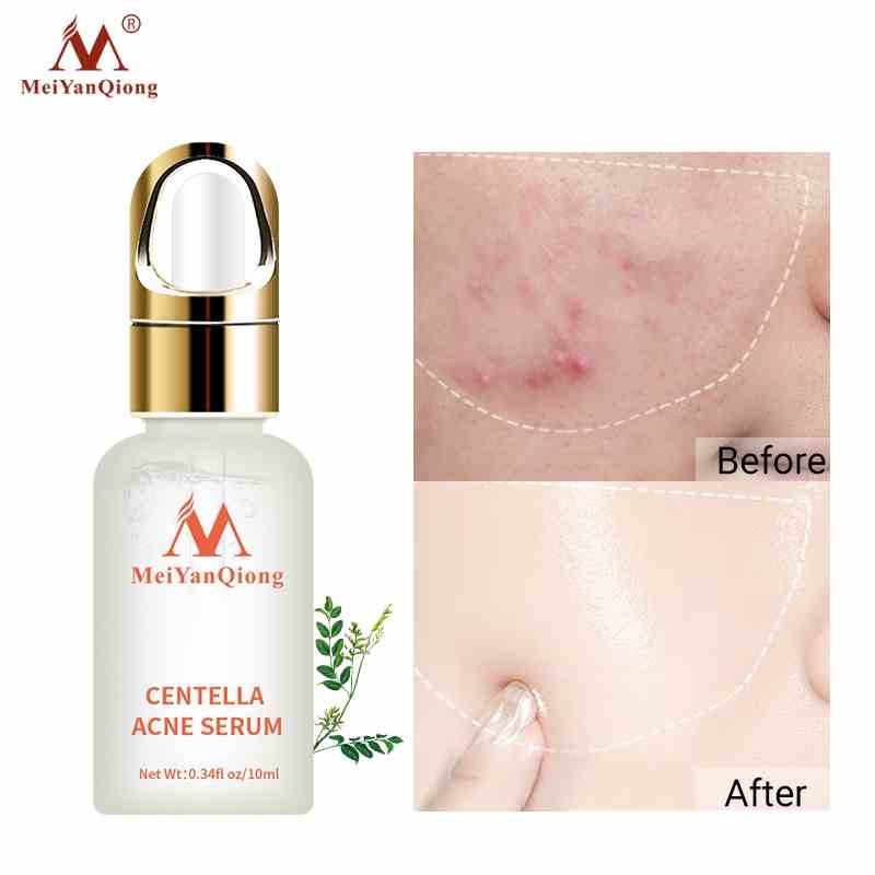 Serum hỗ trợ trị Mụn Trứng Tinh Chất Rau Má MeiYanQiong Kiềm Dầu Và Dưỡng Ẩm 10ml